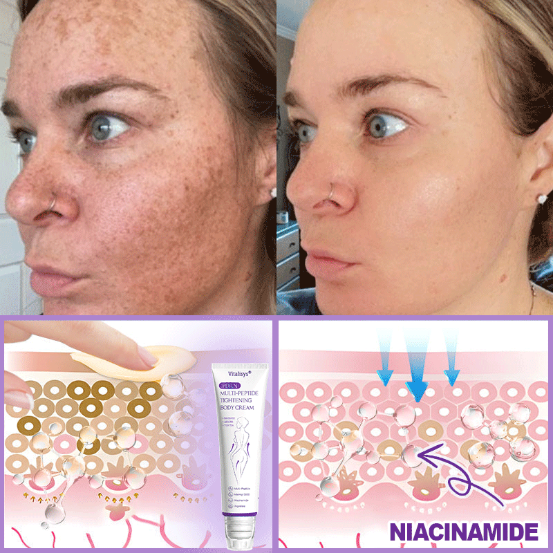 Vitalisys®🇺🇸PDRN Multi-Peptide Massaging Body Roller Cream- Anti-aging, Hydrating, Skin Firming & Lifting, Skin Repair, Even Tone, Acne and Dark Spot Treatment, Wart and Mole Removal, and Psoriasis Relief
