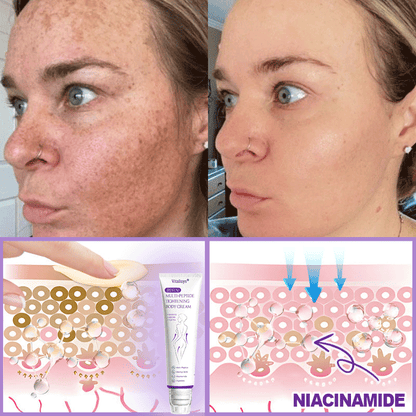 Vitalisys®🇺🇸PDRN Multi-Peptide Massaging Body Roller Cream- Anti-aging, Hydrating, Skin Firming & Lifting, Skin Repair, Even Tone, Acne and Dark Spot Treatment, Wart and Mole Removal, and Psoriasis Relief