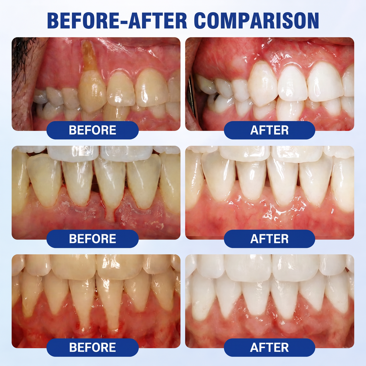 🇺🇸 VITALISYS®🦷 𝑮𝒖𝒎𝑹𝒆𝒗𝒊𝒗𝒆 Gum & Periodontal Care Gel🍇