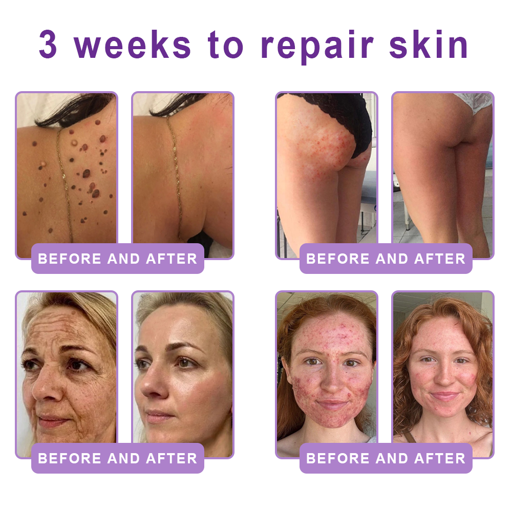 Vitalisys®🇺🇸PDRN Multi-Peptide Massaging Body Roller Cream- Anti-aging, Hydrating, Skin Firming & Lifting, Skin Repair, Even Tone, Acne and Dark Spot Treatment, Wart and Mole Removal, and Psoriasis Relief