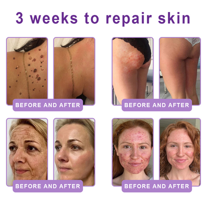 Vitalisys®🇺🇸PDRN Multi-Peptide Massaging Body Roller Cream- Anti-aging, Hydrating, Skin Firming & Lifting, Skin Repair, Even Tone, Acne and Dark Spot Treatment, Wart and Mole Removal, and Psoriasis Relief