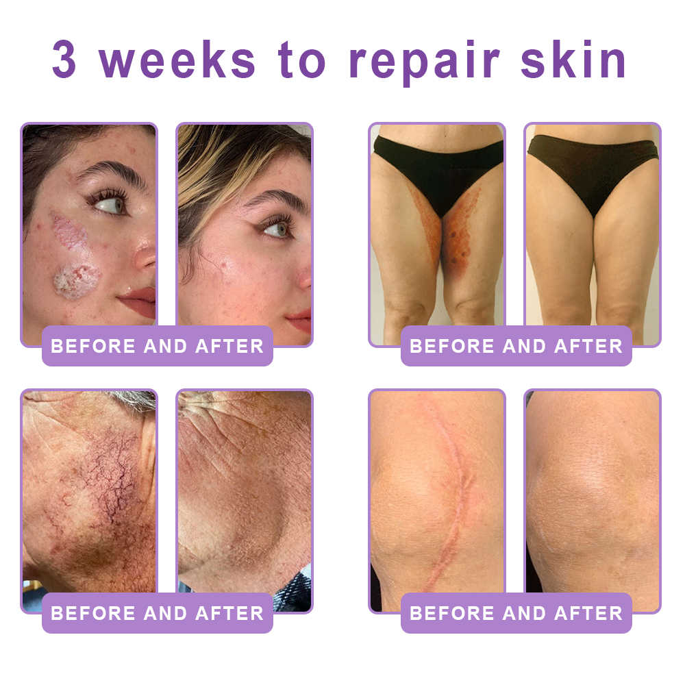Vitalisys®🇺🇸PDRN Multi-Peptide Massaging Body Roller Cream- Anti-aging, Hydrating, Skin Firming & Lifting, Skin Repair, Even Tone, Acne and Dark Spot Treatment, Wart and Mole Removal, and Psoriasis Relief