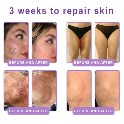 Vitalisys®🇺🇸PDRN Multi-Peptide Massaging Body Roller Cream- Anti-aging, Hydrating, Skin Firming & Lifting, Skin Repair, Even Tone, Acne and Dark Spot Treatment, Wart and Mole Removal, and Psoriasis Relief